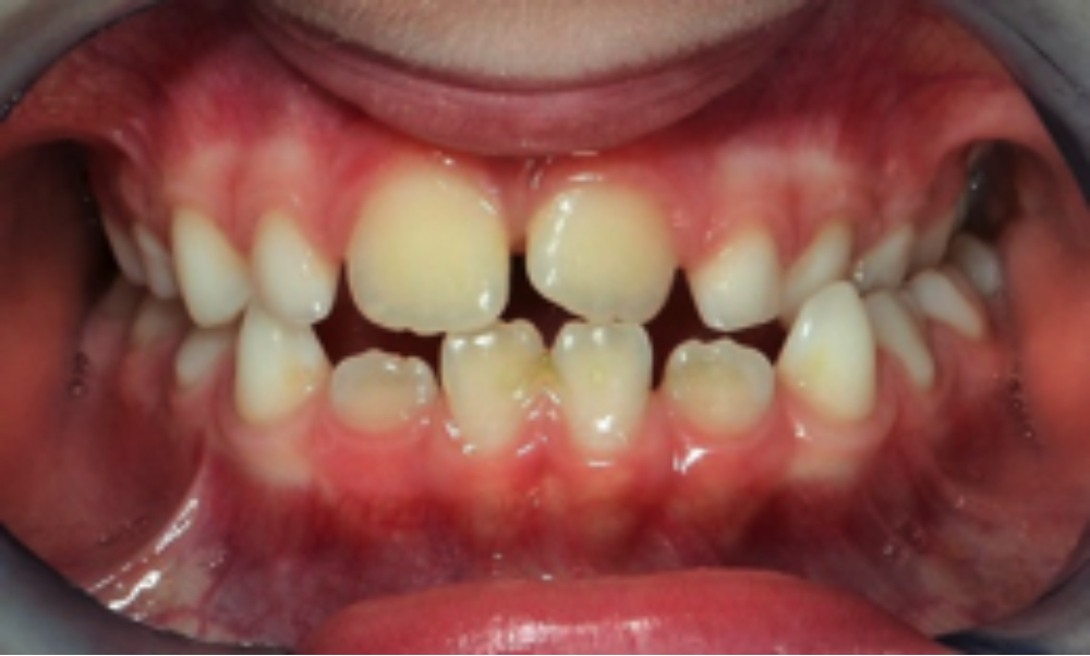 Ages suitable for Orthodontics