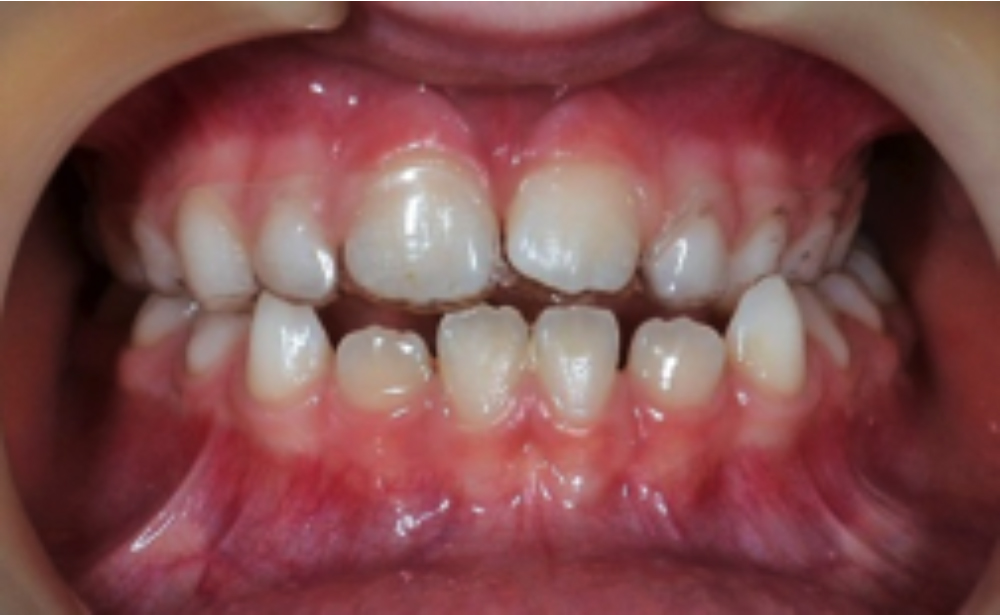 Ages suitable for Orthodontics