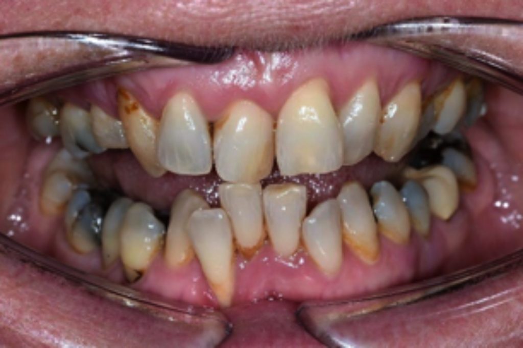 Ages suitable for Orthodontics