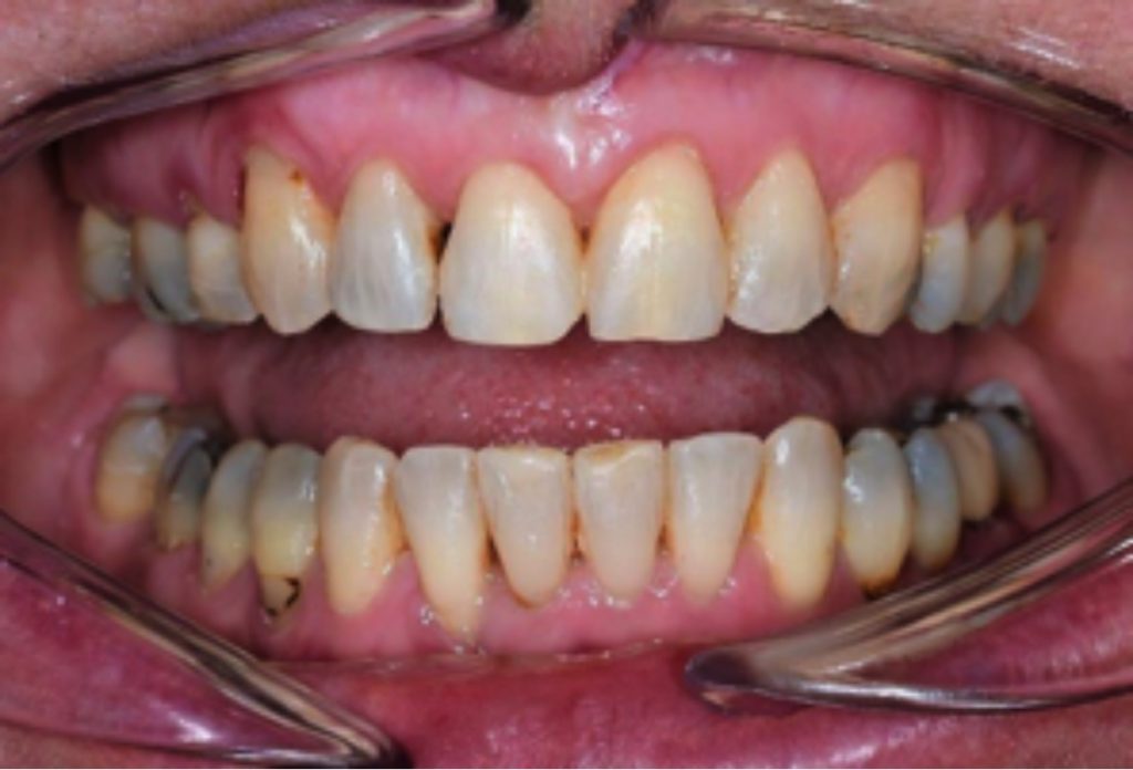 Ages suitable for Orthodontics