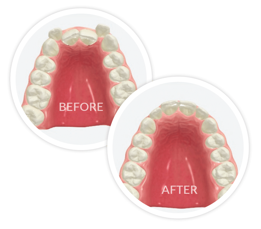 The Priestgate Clinic Aligner