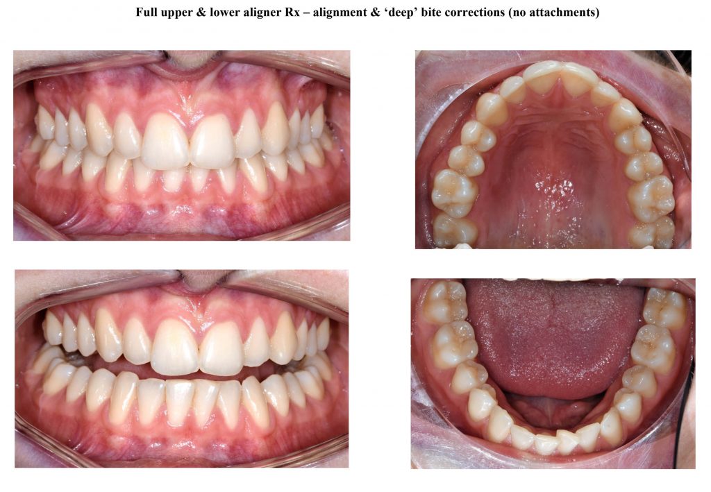 Orthodontic Aligners Plastic Braces
