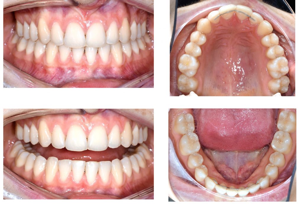 Orthodontic Aligners Plastic Braces after