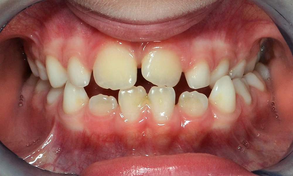 transparent plastic braces