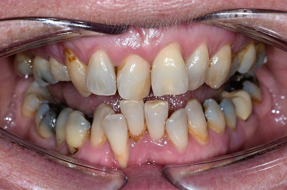 transparent plastic braces