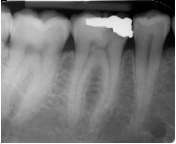 root canal