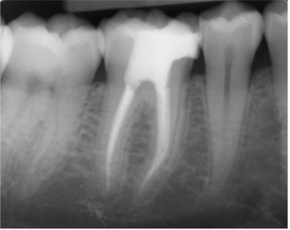 root canal